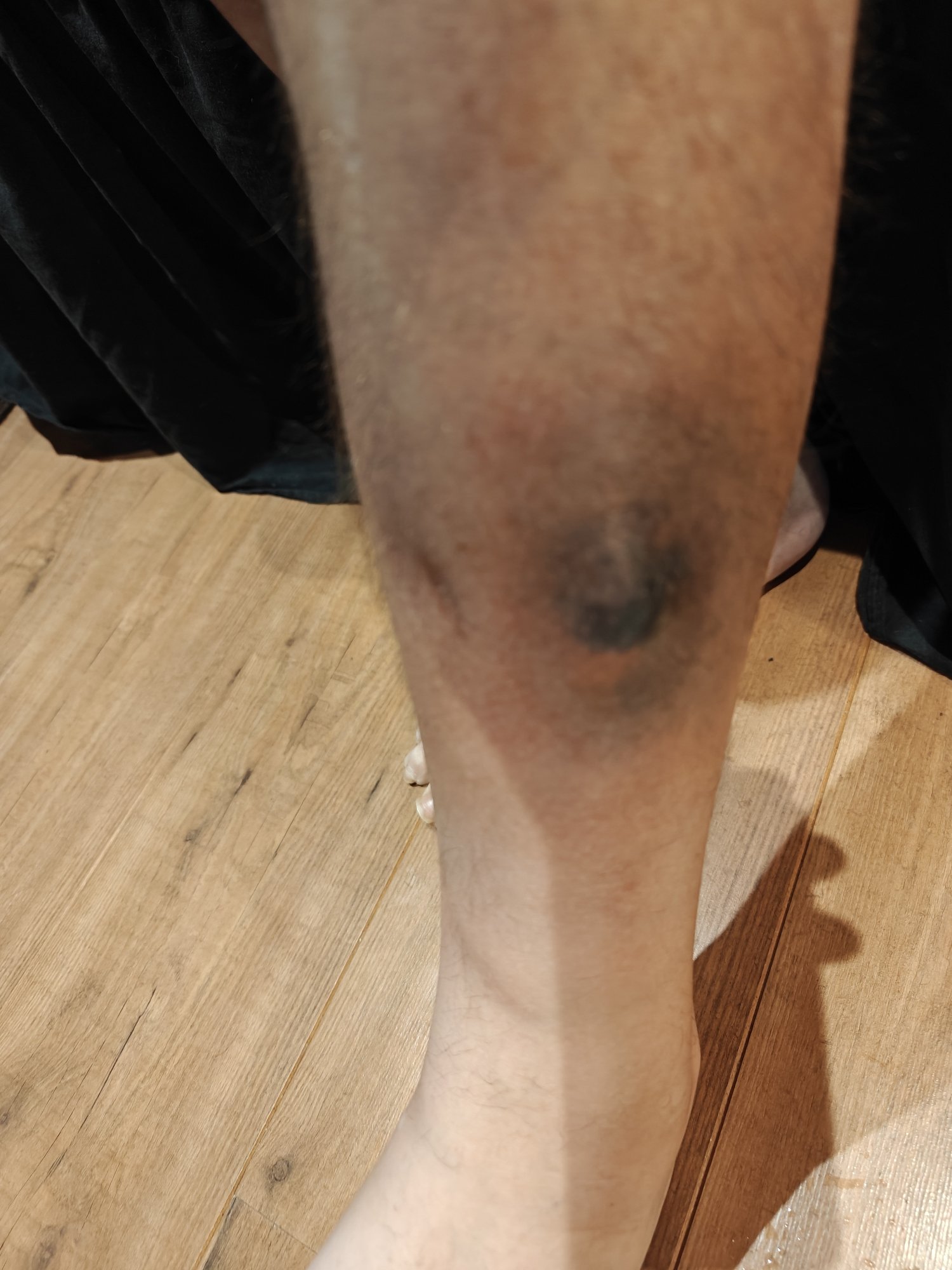 A leg with a MEGA bruise 