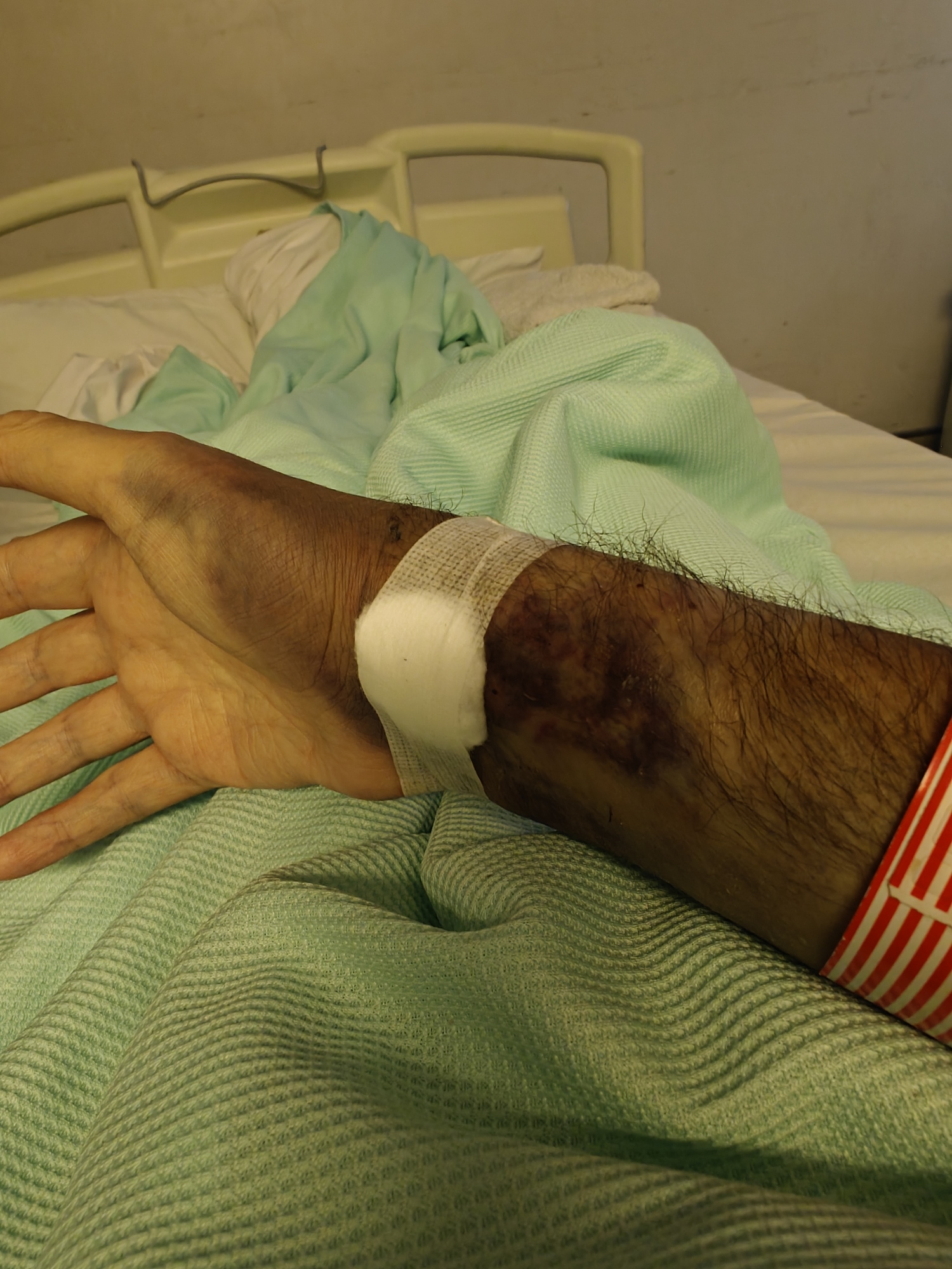 A very bruised arm with bad hematoma 