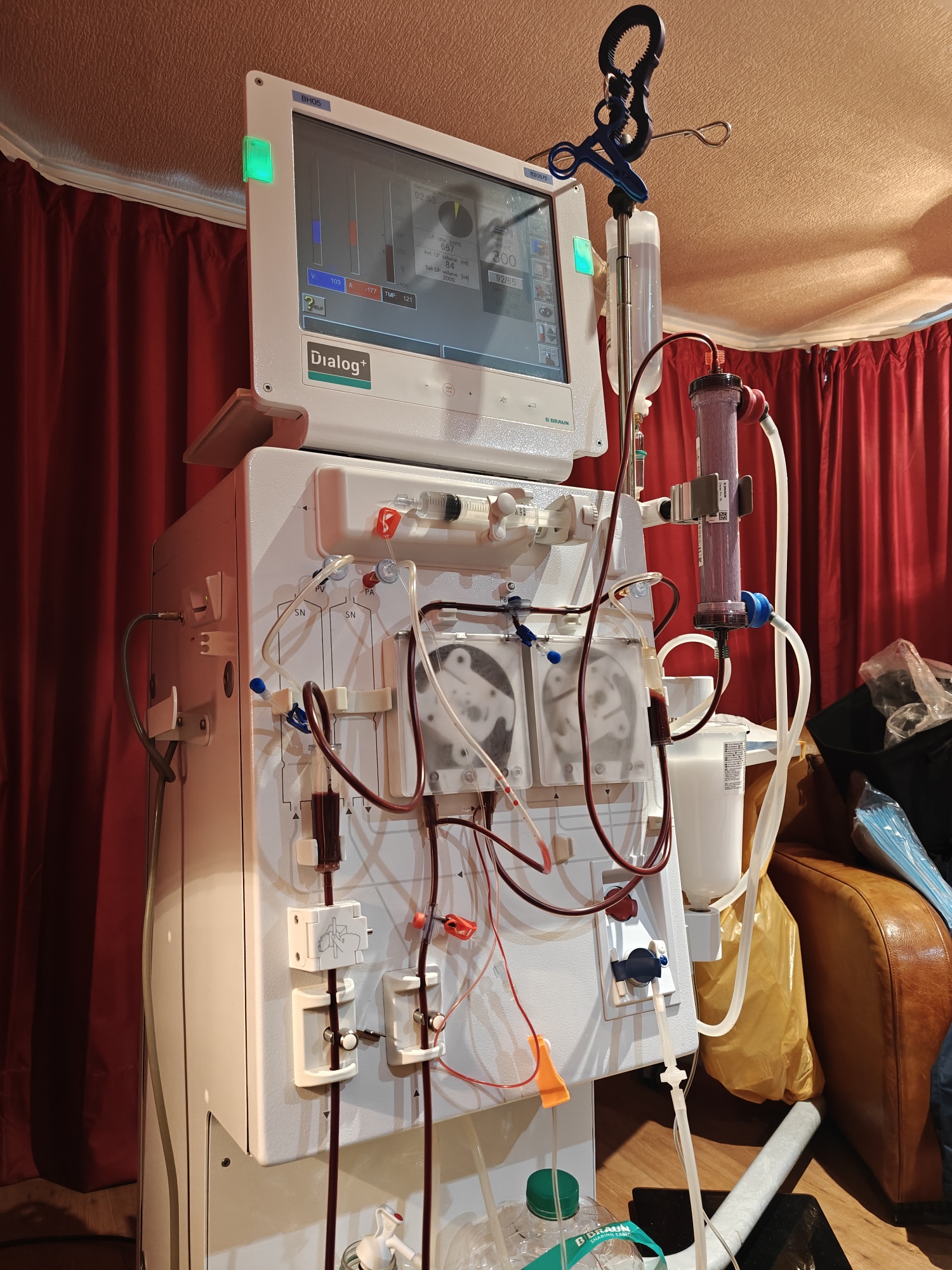 A BBraun haemodialysis machine in operation, with blood running round the circuit 